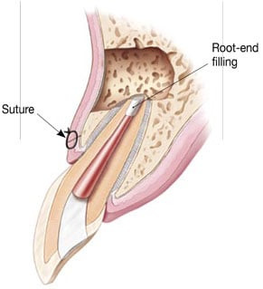 Illustration of the replacement filling at the root tip and where the suture will be