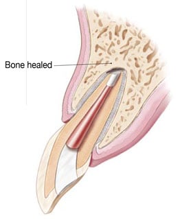 Illustration of the healed bone surrounding the root tip